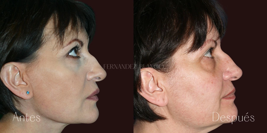 Perfil derecho del antes y después de una liposucción de papada de Wendy en la Clínica Fernández Blanco