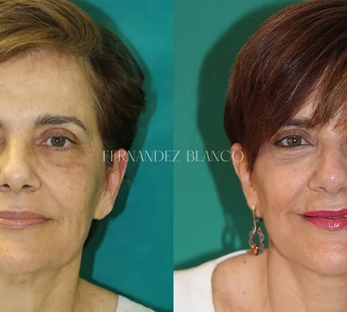 Vista frontal del antes y después de una cirugía de lifting cérvico facial realizada en la Clínica FB