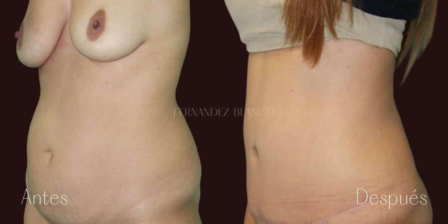 Vista diagonal del antes y después de abdominoplastia realizada en la Clínica FB a paciente Alma