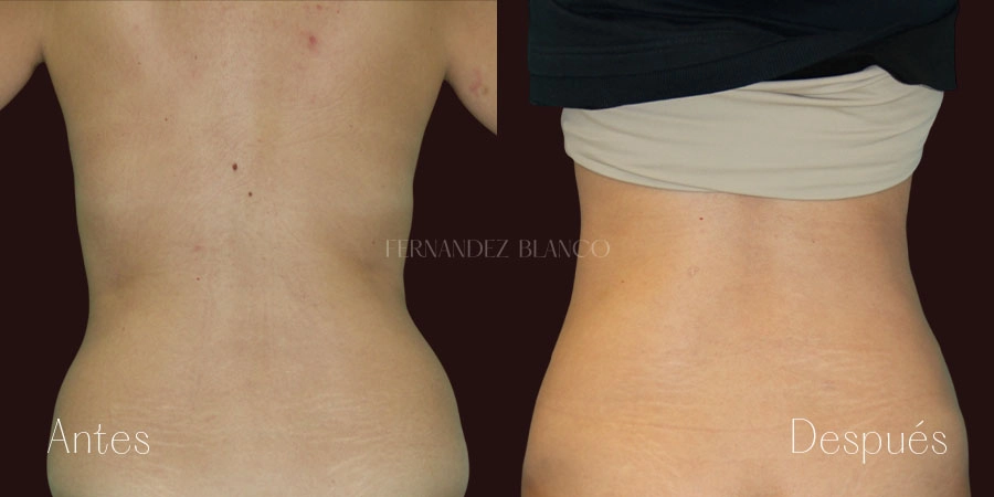 Antes y después de abdominoplastia realizada en la Clínica FB caso 2