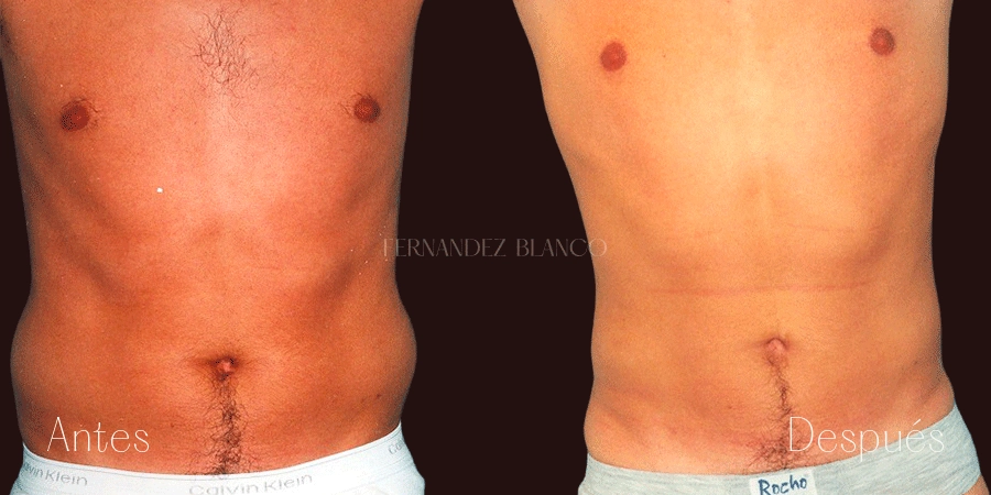 Caso 2 de cirugía masculina: Antes y después de liposucción de abdomen y flancos
