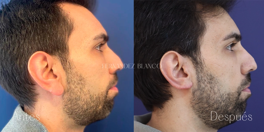 Cirugía de Oreja | Casos Antes y Después | Clínica FB