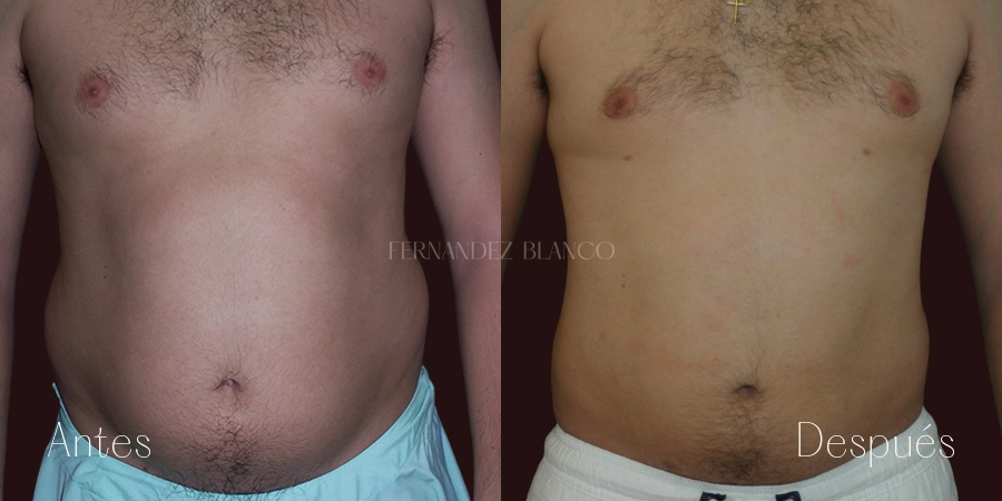 Antes y después de una liposucción grande de abdomen y flancos con 3 meses de evolución tras la operación