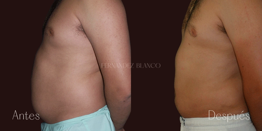Caso 4 de cirugía masculina, liposucción realizada a paciente Noah en la Clínica Fernández Blanco