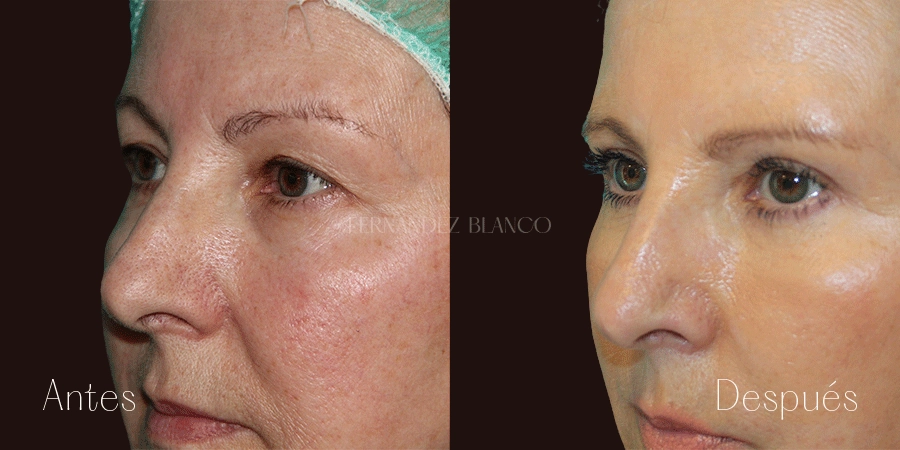 Vista diagonal del antes y después de Gloria tras hacerse una blefaroplastia superior