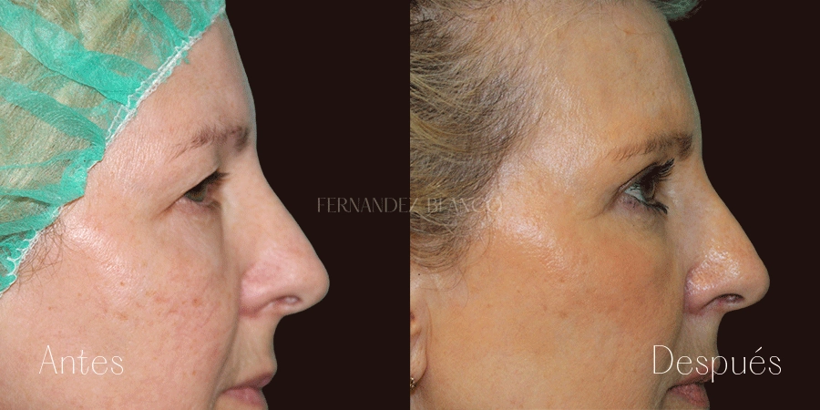 Perfil derecho del antes y después de una blefaroplastia con 6 meses de evolución realizada por el Dr. Fernández Blanco