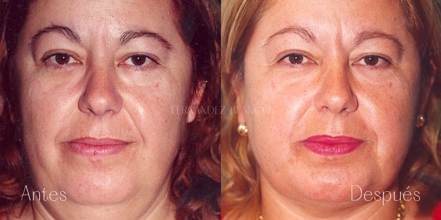 Caso 9 de liposucción de papada