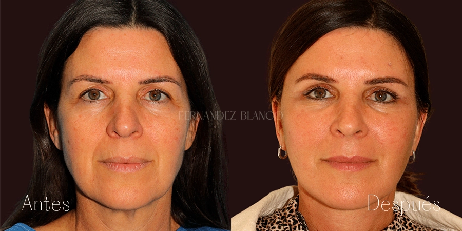 Vista frontal antes y después de lifting facial R3 con técnica deep-plane, elevación de mejillas y rejuvenecimiento del cuello