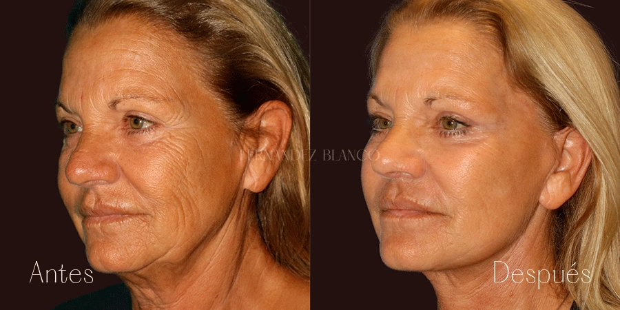 Vista diagonal izquierda de resultado a 6 meses de lifting cervicofacial realizado por el Dr. Fernández Blanco