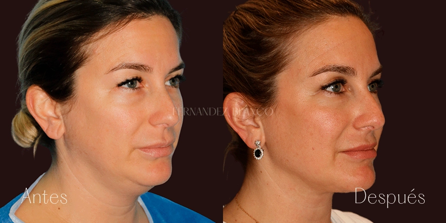 Vista diagonal derecha después de liposucción cervical y extracción subplatismal, mejora en cuello y mentón