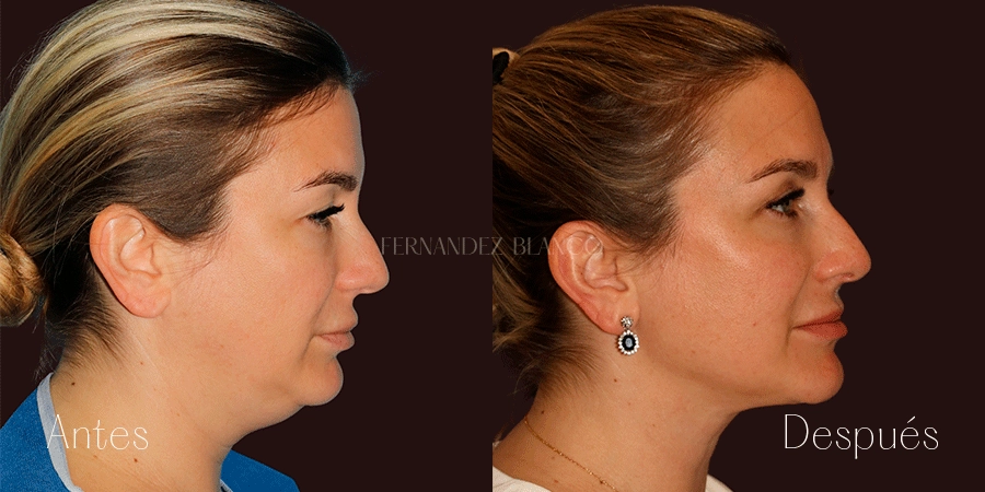 Perfil derecho de paciente a 3 meses de lipo de cuello y definición del ángulo mandibular, por el Dr. Fernández Blanco