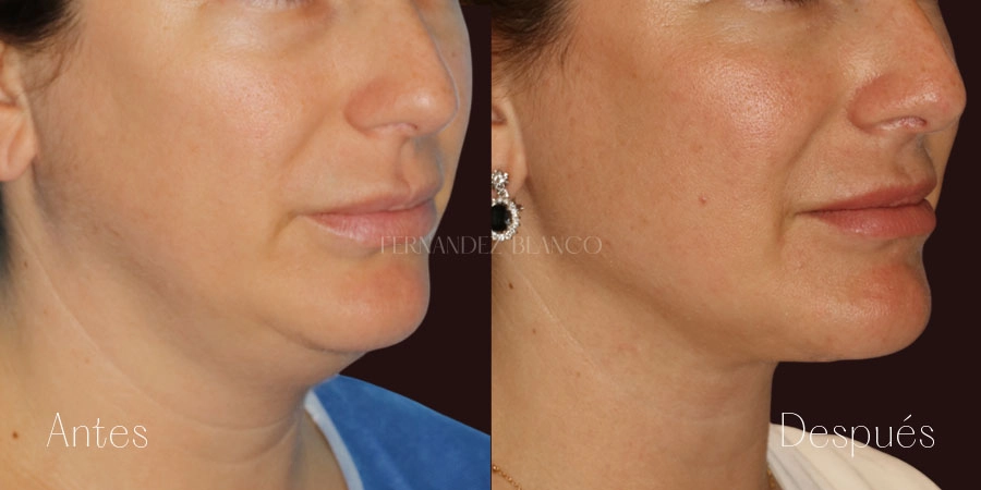 Vista diagonal derecha después de liposucción cervical y extracción subplatismal, mejora en cuello y mentón
