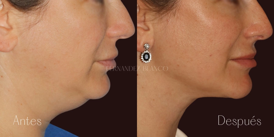 Perfil derecho de paciente a 3 meses de lipo de cuello y definición del ángulo mandibular, por el Dr. Fernández Blanco