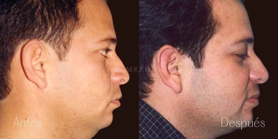 Perfil derecho de Alejandro. Vista del antes y después de una cirugía de liposucción de papada