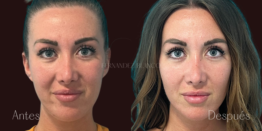 Vista frontal antes y después de liposucción de papada, mejora en volumen y definición mandibular a los 3 meses