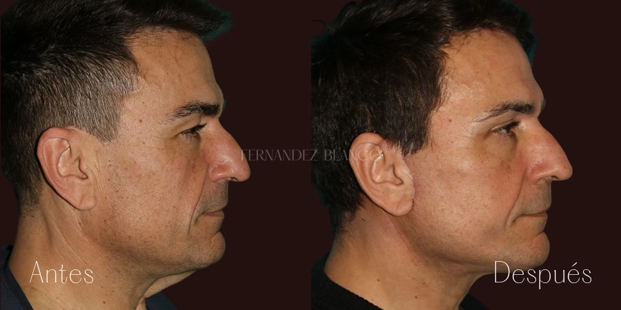 Perfil derecho de paciente hombre tras liposucción de papada realizada por el Dr. Fernández Blanco, evolución de 2 meses