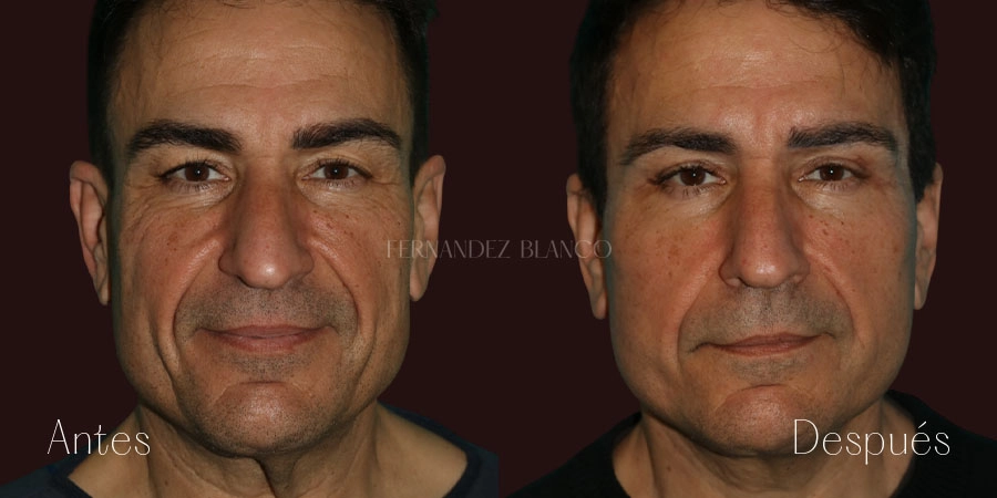 Vista frontal de paciente masculino tras liposucción de papada, 2 meses de evolución, Dr. Fernández Blanco