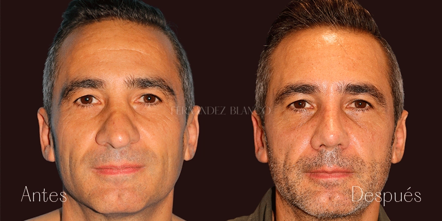 Rinoplastia secundaria: Caso de Cristian, hombre que se hizo esta operación en la Clínica Fernández Blanco