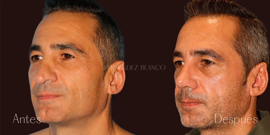 Rostro de Cristian tras hacerse una Rinoplastia secundaria en la Clínica Fernández Blanco