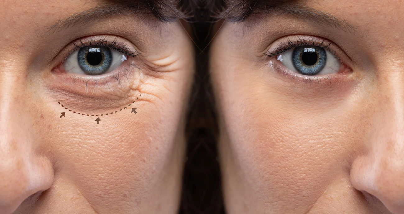 Blefaroplastia Precio: ¿Cuánto cuesta hacerse una cirugía de párpados en España en este 2025?