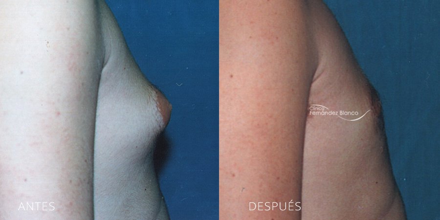 Before and after gynecomastia in men