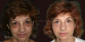 Blepharoplasty Price: How Much Does Eyelid Surgery Cost in Spain?