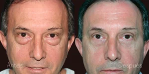 Frequently Asked Questions About Blepharoplasty Cost