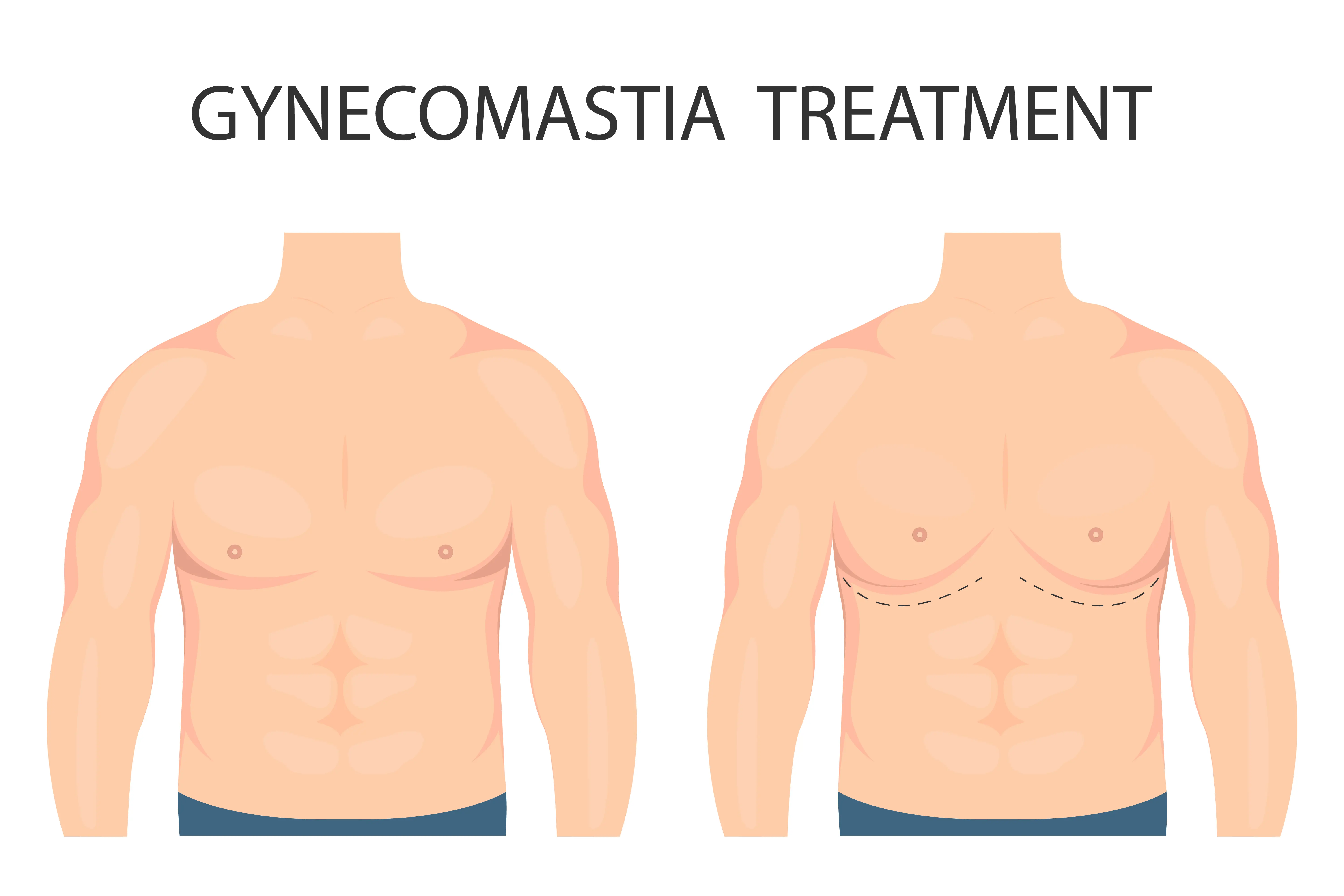 Gynecomastia Price in 2026: How much does male breast reduction cost in Spain