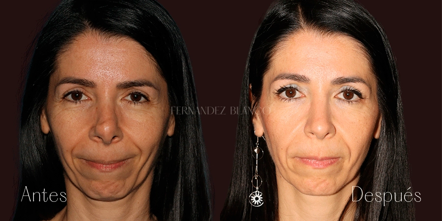 How Much Does a Secondary Rhinoplasty Cost in Spain in 2026?