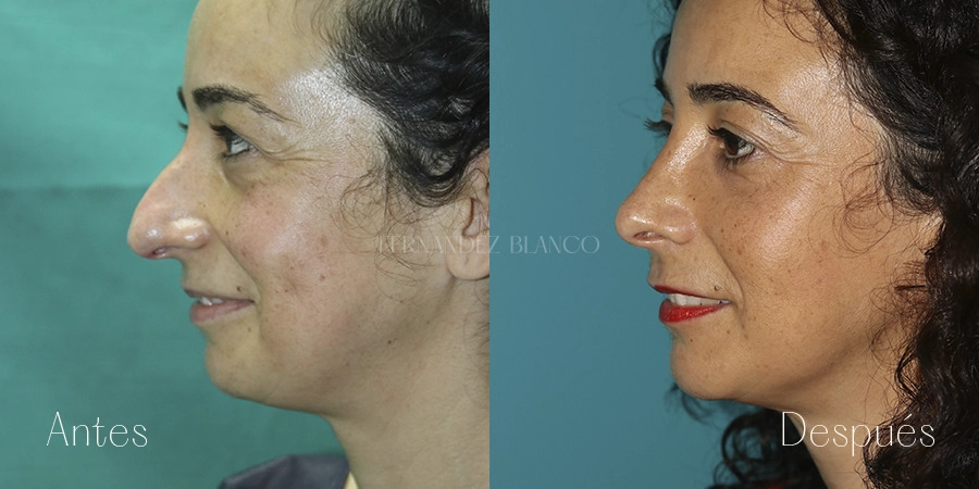 Rinoplastia precio 2026: Conoce cuanto cuesta operarse la nariz en España