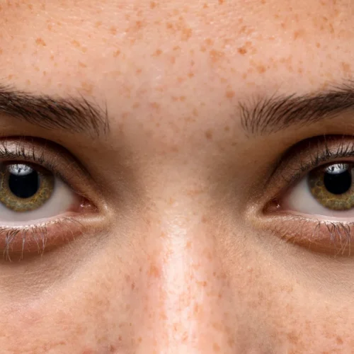 Acercamiento de ojos con Blefaroplastia en Madrid