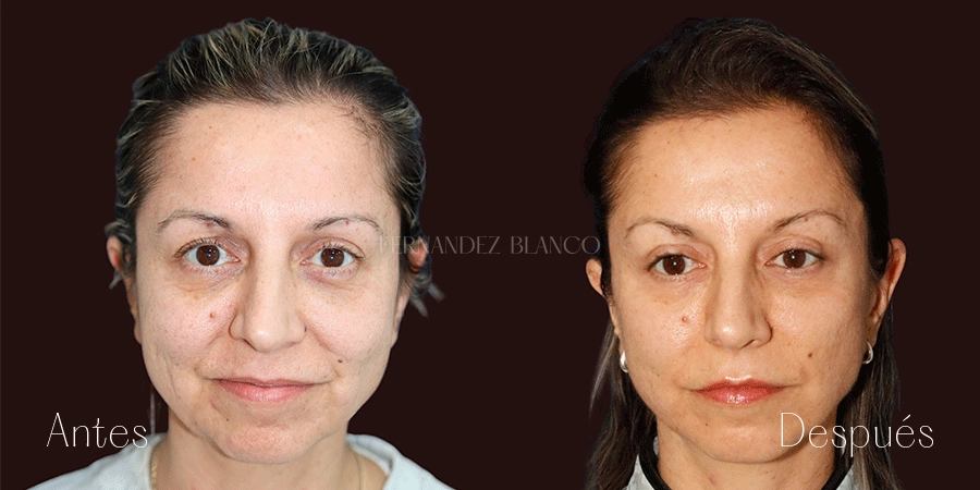 Resultado de Minilifting facial en Marbella - cirugía de una zona en paciente con flacidez parcial