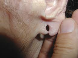 Reconstrucción del lóbulo de la oreja